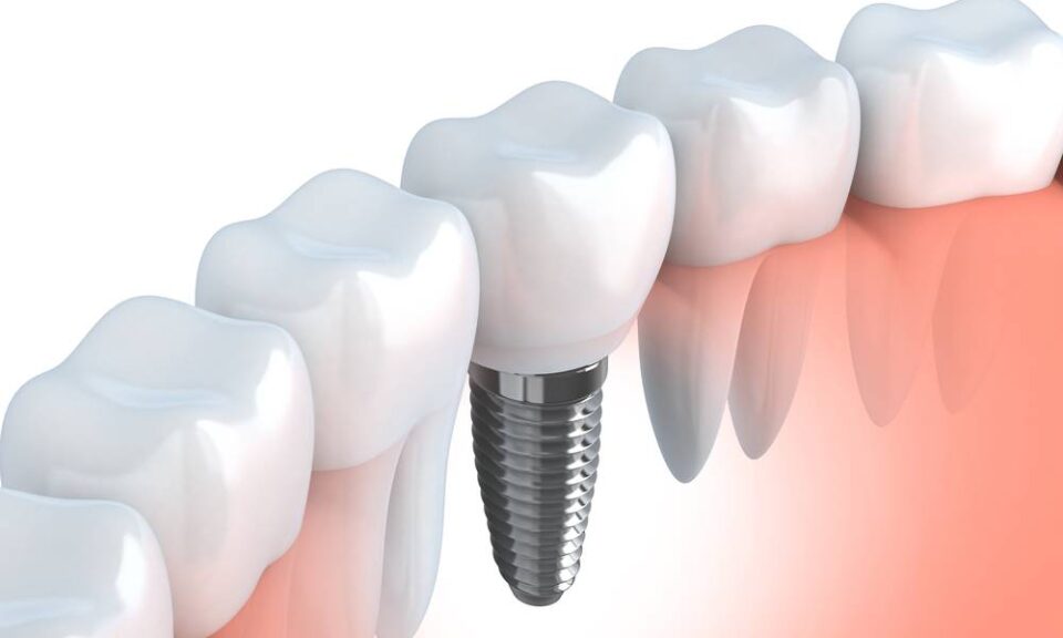 Restoring Your Smile, Boosting Your Confidence