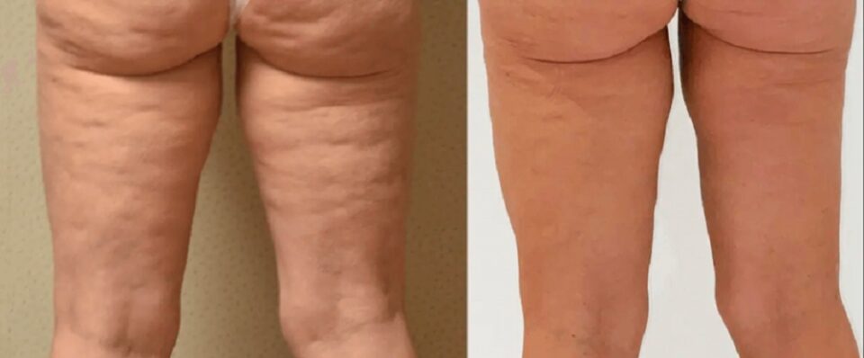 AirSculpt Explained: Benefits and Procedure