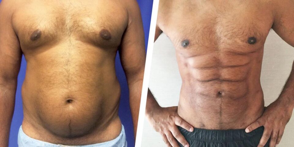 six-pack surgery